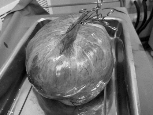 महिला के पेट से 15.5 किलो ट्यूमर निकाला:PMCH में डॉक्टरों ने लेबर रूम में किया ऑपरेशन, महिला को लंबे समय से थी समस्या