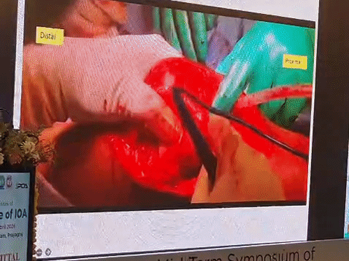 प्रयागराज में मिड-टर्म सिंपोजियम की शुरूआत:ऑर्थोपेडिक विशेषज्ञों का कम बजट उपचार पर विशेष जोर, मरीजों के लिए सस्ते इम्प्लांट की चर्चा