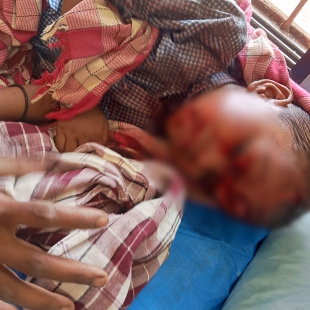 4 साल के बच्चे को कुत्ते ने दौड़ा-दौड़ाकर काटा:हालत गंभीर, सिर-मुंह समेत 17 जगहों पर गहरे जख्म के निशान; घर के पास खेल रहा था