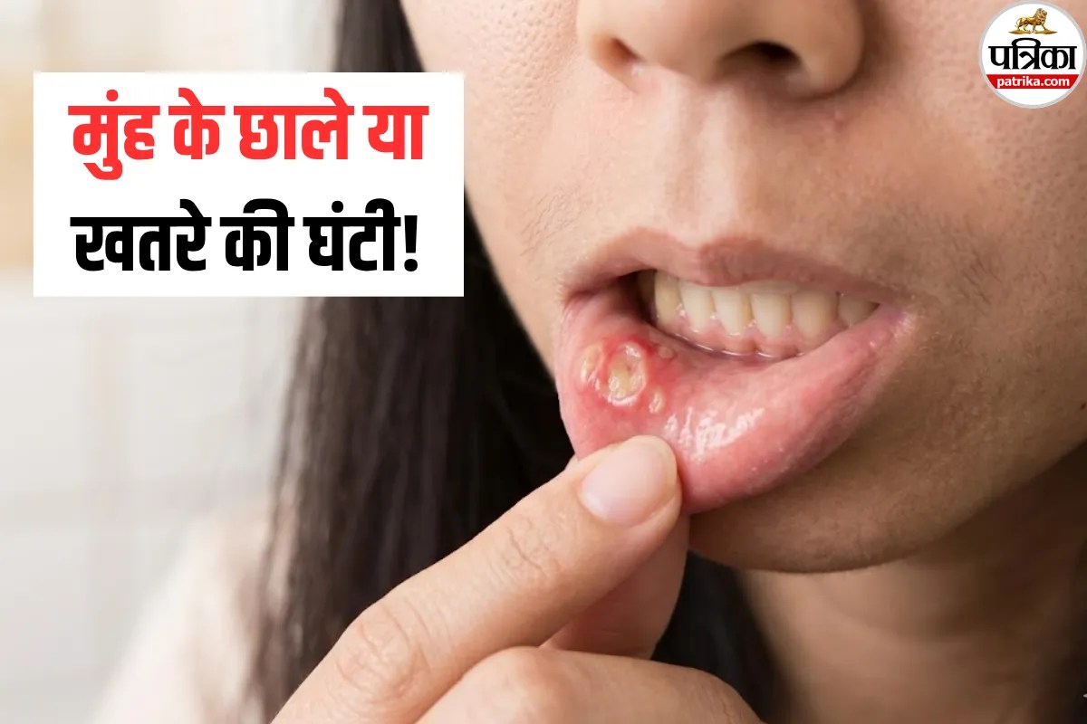 Frequent Mouth Ulcers: बार-बार होते हैं मुंह में छाले, तो हो सकते हैं गंभीर बीमारियों के संकेत