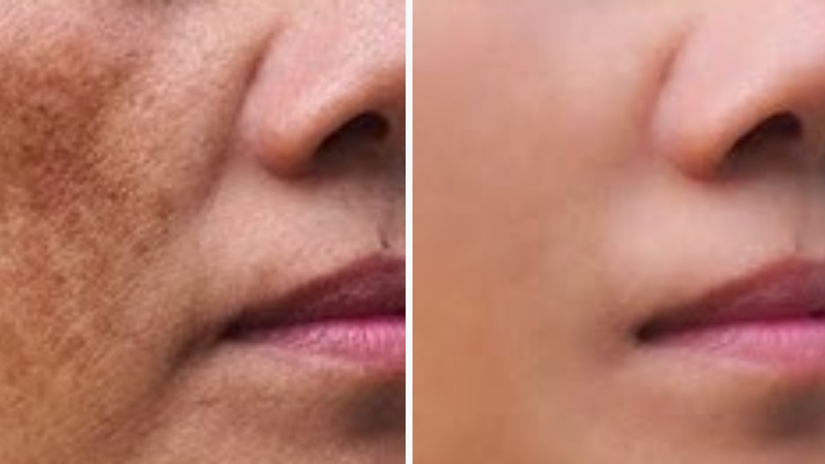 चेहरे पर दिखाई देने लगी हैं झाइयां, घर पर बनाएं फेस पैक, झाइयों को कम करने के लिए नेचुरल उपाय