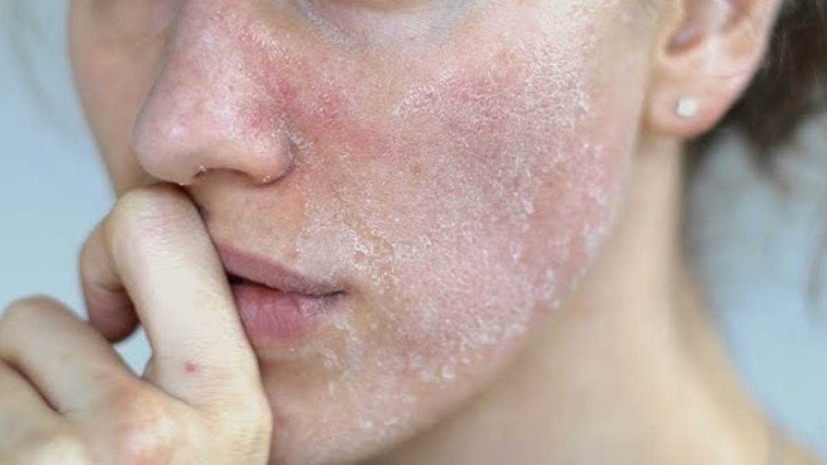 रूखी-बेजान त्वचा को मुलायम कैसे बनाएं, पपीते के गूदे में मिलाएं बस एक चीज, और फिर चेहरे पर लगाएं