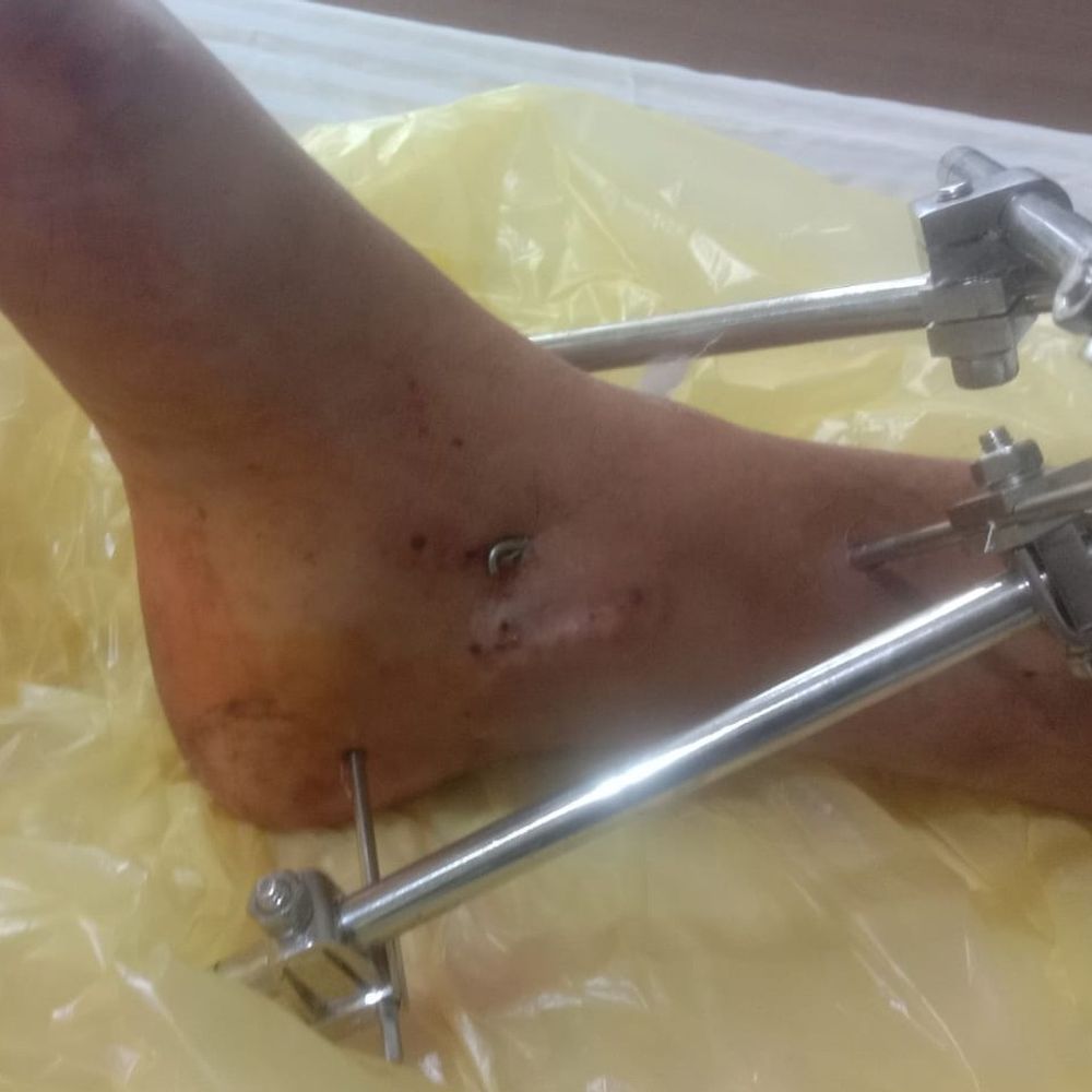 सिरसा में गाड़ी ने बाइक को मारी टक्कर, युवक घायल:बेटे के साथ गांव जा रहा था, सड़क किनारे रूका था, ऑपरेशन हुआ