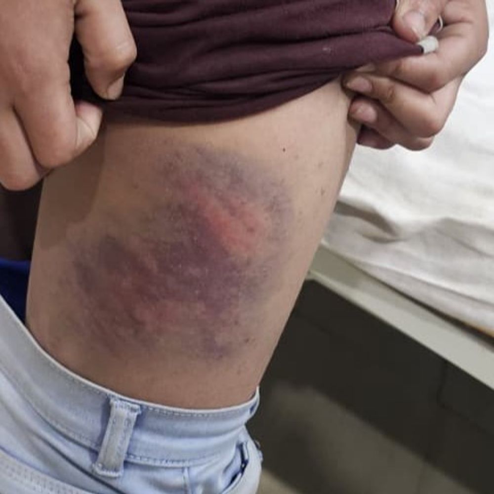 शिक्षक ने छात्र को वायर से पीटा, अस्पताल में भर्ती:त्रिवेणीगंज के निजी स्कूल का मामला, पुलिस को शिकायत नहीं