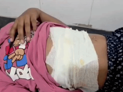 आवारा कुत्तों ने 8 साल की मासूम को नोचा:चाच के घर जा रही थी;चेहरा,आंख, गर्दन, पेट और कमर पर किया हमला