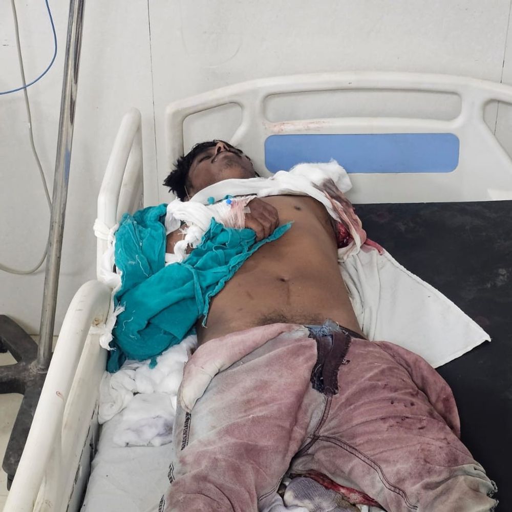 छिंदवाड़ा में ट्रेन से युवक का हाथ कटा:कुत्ता मुंह में दबाकर ले भागा; 6 घंटे बाद मिला, डॉक्टर बोले- अब नहीं जोड़ सकते