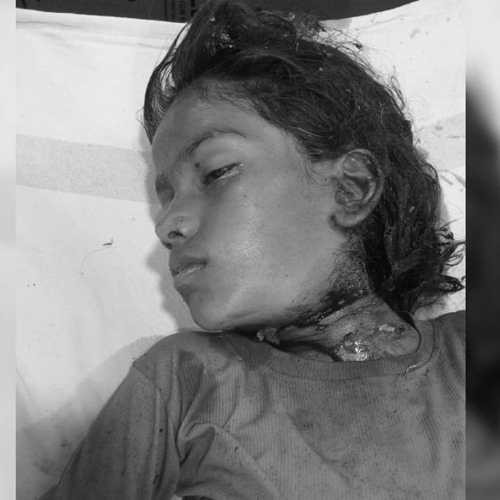 कुत्तों के झुंड ने बच्ची को नोंचकर मार डाला:गली में खेल रही 12 साल की बच्ची पर अचानक किया हमला, अस्पताल ले जाने के दौरान मौत