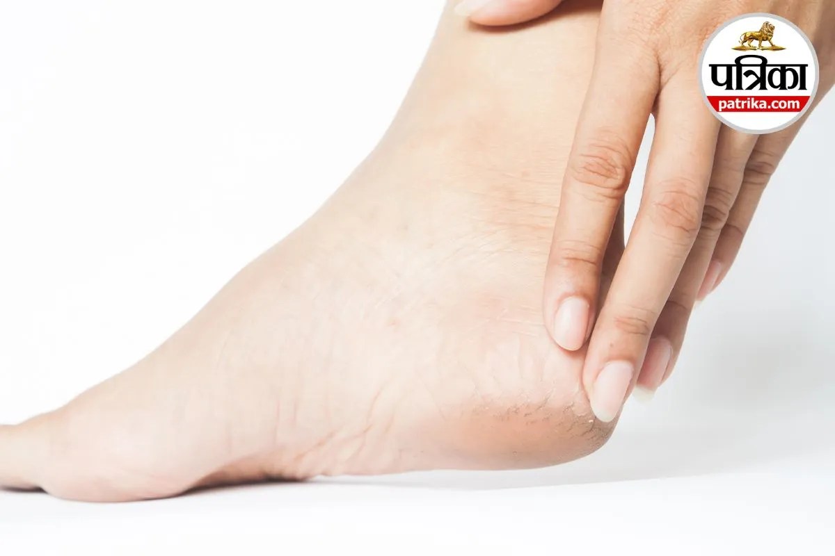 Cracked Heels Causes: डायबिटीज और थायराइड के कारण भी फट सकती हैं एड़ियां, डॉक्टर से जानें इसकी वजह