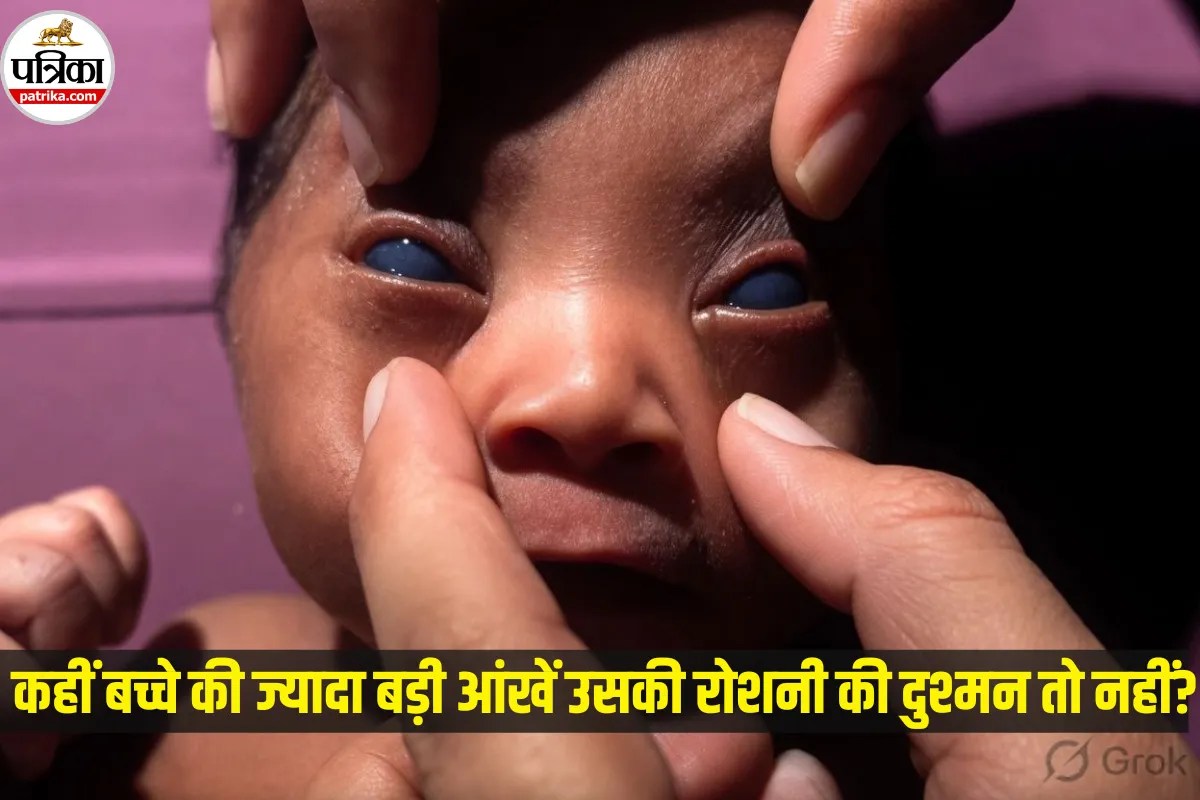 ज्यादा बड़ी आंखें खूबसूरती नहीं, हो सकती हैं गंभीर बीमारी का संकेत! समय पर इलाज कराएं वरना छिन सकती है रोशनी
