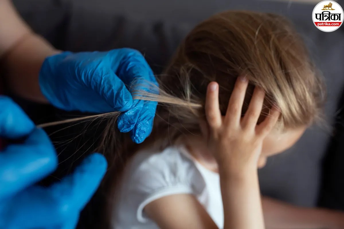 Head lice and Anemia: बालों में जूं को हल्के में न लें! डर्मेटोलॉजिस्ट ने बताया एनीमिया से कनेक्शन