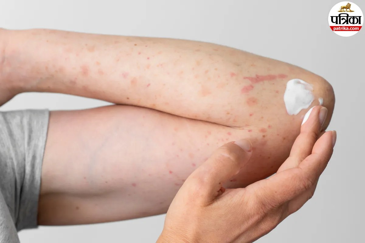 Summer Skin Problems : डर्मेटोलॉजिस्ट ने समझाया गर्मी में स्किन इंफेक्शन और घमौरियों के बीच का अंतर; बचाव के टिप्स भी शेयर किए