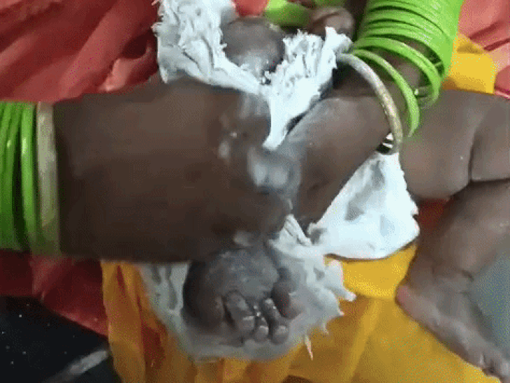 एसएन ओपीडी में मां ने काटा बच्चे का प्लास्टर:पूछने पर बोली डॉक्टर ने कहा खुद हटा लेना, वीडियो आया सामने