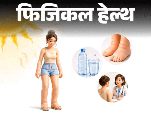 फिजिकल हेल्थ- हीट एडेमा क्या है:गर्मियों में बढ़ते केस, डॉक्टर से जानें इसके लक्षण, किसे ज्यादा रिस्क, बचाव के लिए जरूरी सावधानियां