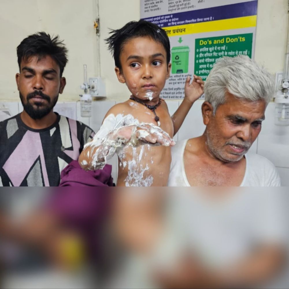5 साल के बच्चे ने गर्म तेल में डाला हाथ:गंभीर रूप से झुलसा; हाथ, चेहरा और गले पर पड़े छाले
