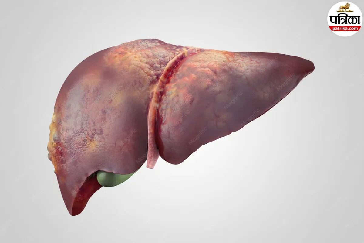 Fatty Liver Symptoms: आंखों से हो सकती है फैटी लिवर की पहचान, दिखते हैं सूखापन, जलन जैसे 5 संकेत