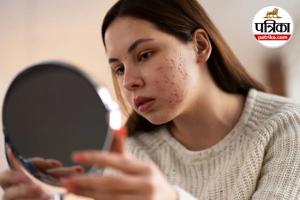 Period Acne: पीरियड्स से पहले चेहरे पर आने वाले दाने क्या बताते हैं आपकी अंदरूनी सेहत के बारे में? गाइनोकोलॉजिस्ट से जानिए