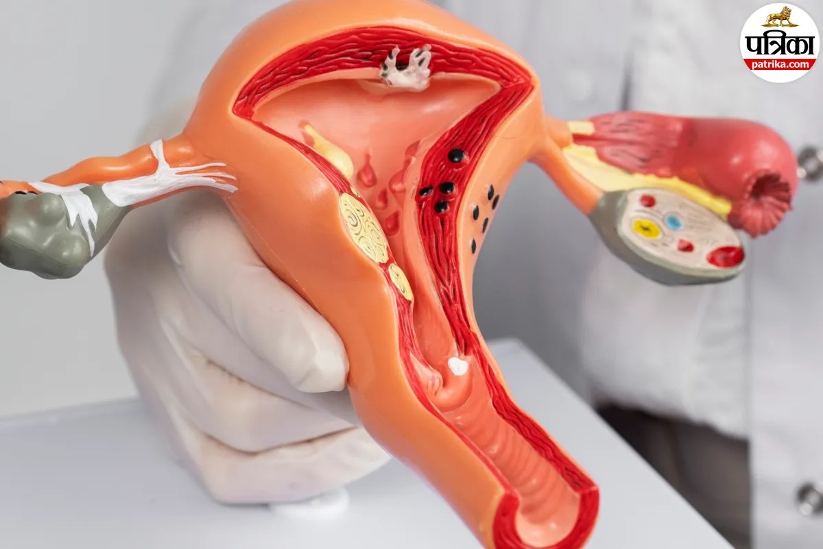 Ovarian Cancer : 20 साल में पहली बार ओवेरियन कैंसर की ऐसी दवा बनी; इंग्लैंड में मिली मंजूरी! इन मरीजों के लिए लाभकारी