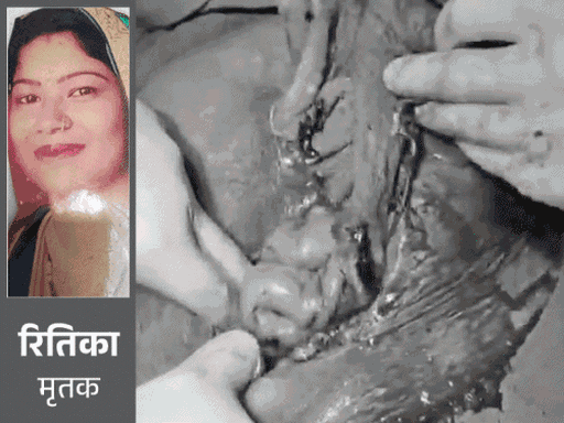 महिला के पेट में तौलिया छोड़ा, मौत हुई:4 दिन बाद भी अस्पताल पर नहीं हुआ एक्शन, डॉक्टर पर भी नहीं हुई कार्रवाई