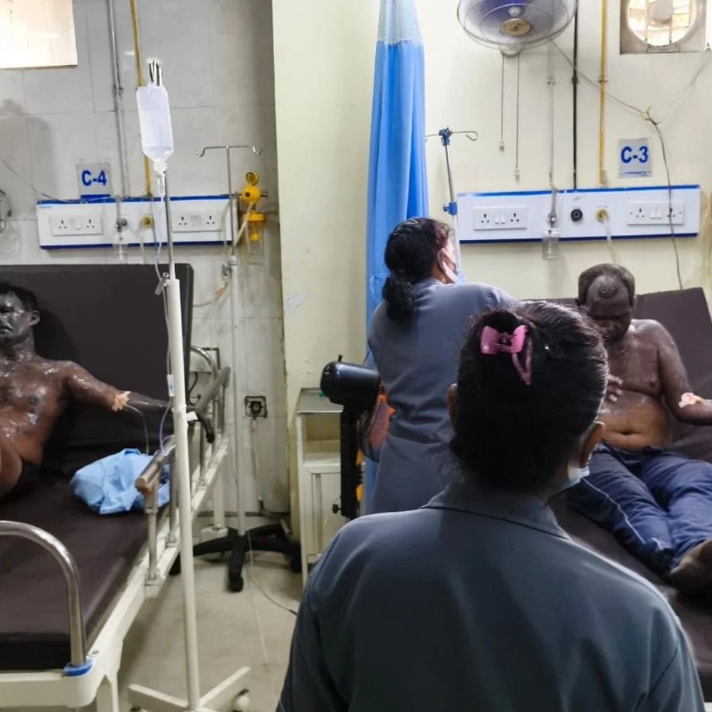 रामगढ़ में फर्नेस ब्लास्ट, 9 मजदूर झुलसे; 2 गंभीर:हादसे के बाद फैक्ट्री में मचा हड़कंप, घायलों को अस्पताल पहुंचाया गया