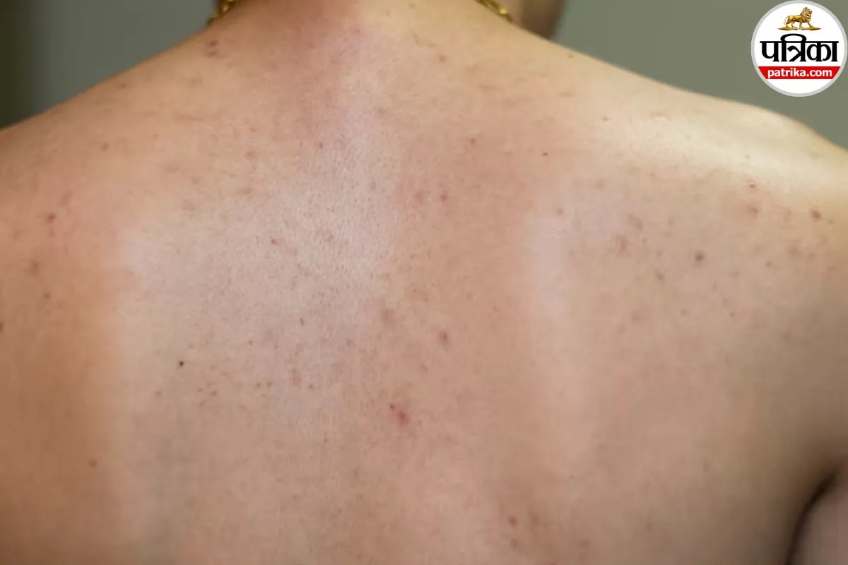 पीठ पर बार-बार निकल रहे हैं दाने? क्लीवलैंड क्लिनिक से जानें Back Acne से छुटकारा पाने के आसान तरीके