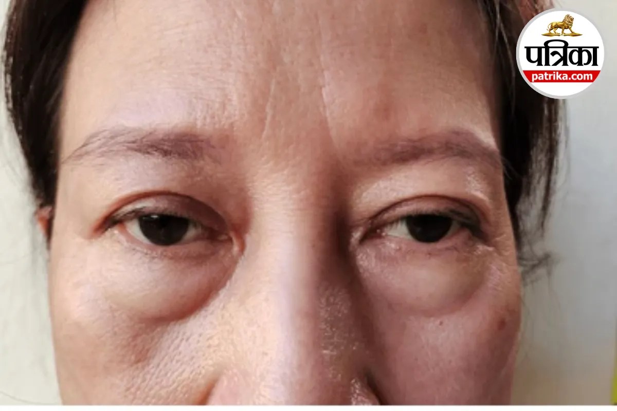 Bags Under Eyes: आंखों के नीचे बार-बार सूजन? नींद की कमी या एलर्जी हो सकता है कारण,जॉन्स हॉपकिन्स मेडिसिन से जानें बचाव