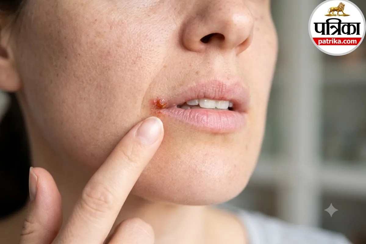 Cold Sores: क्या आपके होठों पर बाहर की तरफ बार-बार निकलते हैं छाले? क्लीवलैंड क्लिनिक से जानें कोल्ड सोर के कारण और लक्षण