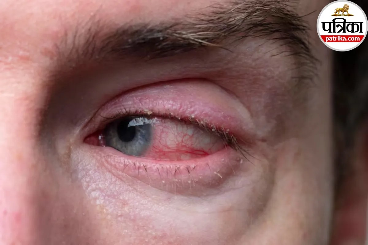 Eye Disease Keratitis: आंख में कुछ चुभने जैसा महसूस हो और लगातार पानी आए तो, हो सकता है केराटाइटिस, क्लीवलैंड क्लिनिक से जानें बचने के उपाय