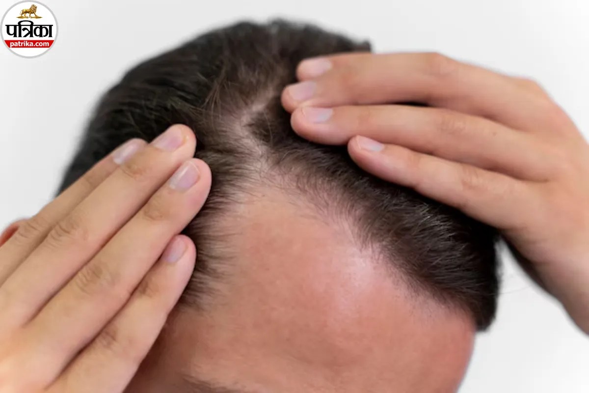 Hair Fall Causes: Cleveland और Mayo Clinic से जानिए वे 10 बीमारियां, जो बालों को करती हैं कमजोर