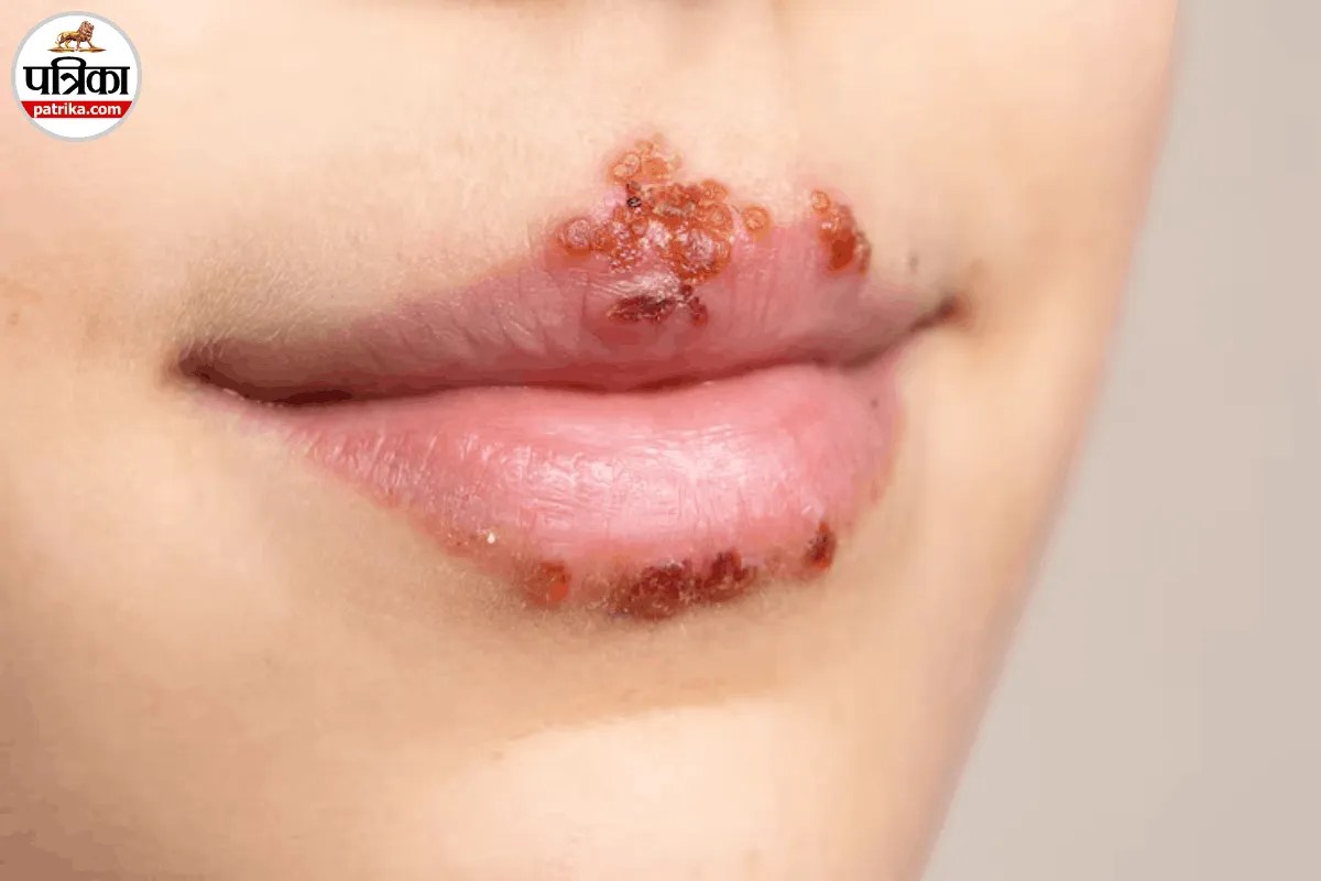 होंठों पर पानी वाले छाले क्यों होते हैं? जानें Herpes Labialis के लक्षण, कारण और बचाव 