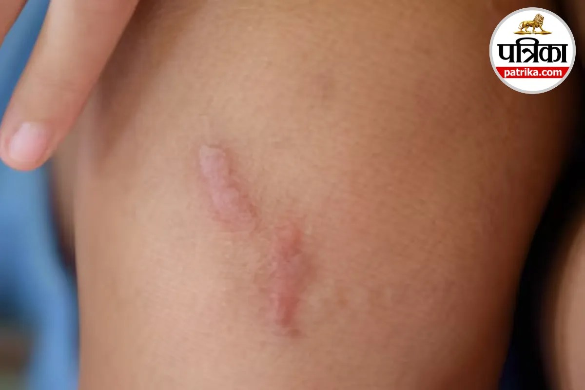 चोट या पियर्सिंग के बाद उभर आया मोटा निशान? हो सकता है Keloid Scar, मेयो क्लिनिक से जानें इसके संकेत