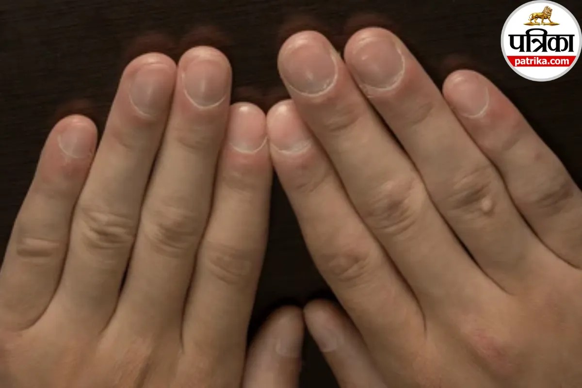 Nail Clubbing: नाखूनों का गोल होना मामूली नहीं, क्लीवलैंड क्लिनिक ने बताया फेफड़ों और दिल की बीमारी का हो सकता है संकेत