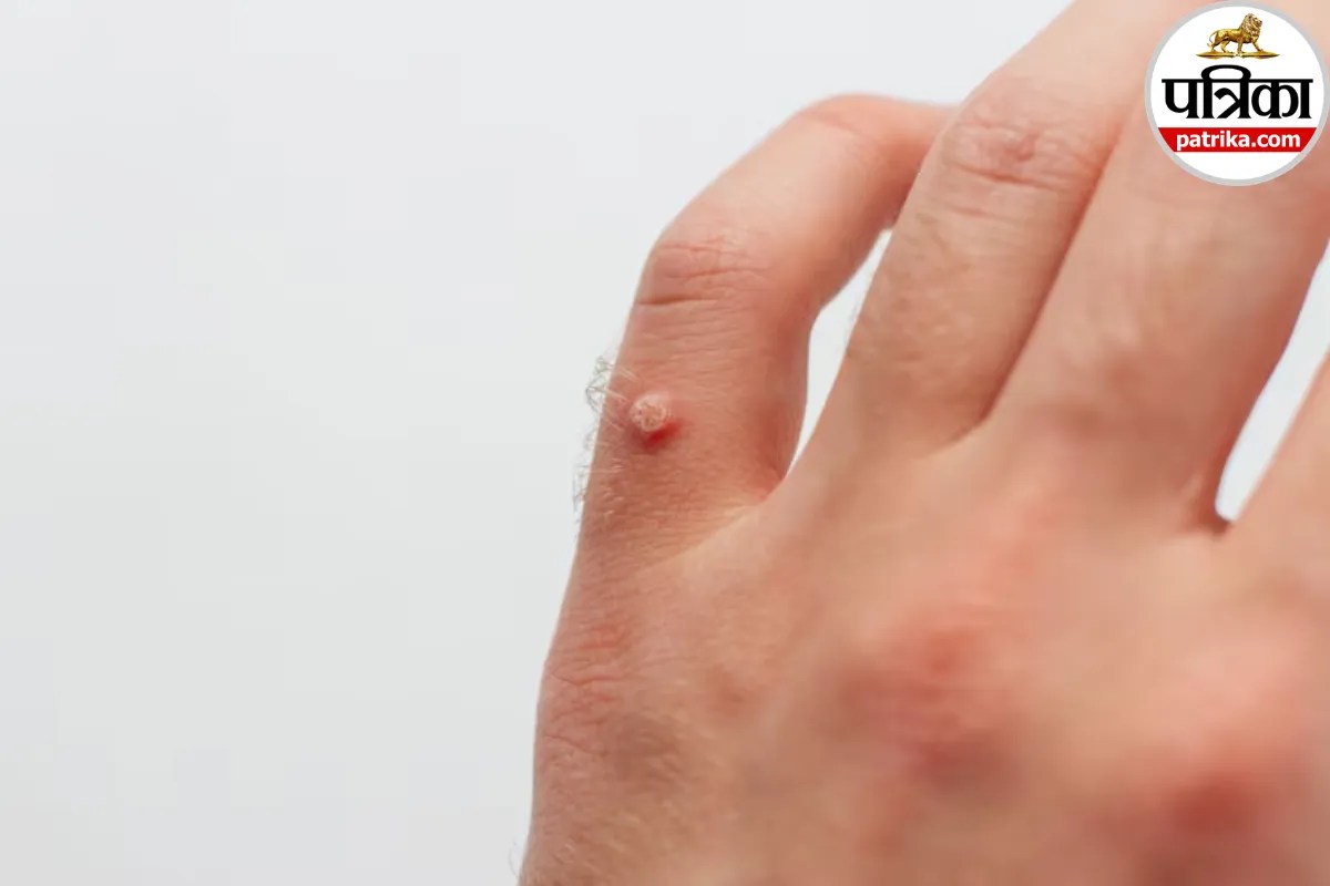 गर्दन, बगल या शरीर पर दिखने वाले Skin Tags क्या हैं? क्लीवलैंड क्लिनिक से जानिए शरीर पर क्यों निकलते हैं मस्से