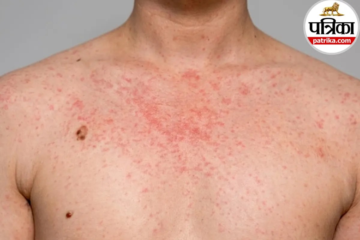 Syphilis: शरीर पर बिना दर्द वाले छाले और रैश को न करें नजरअंदाज, सिफिलिस हो सकता है, मेयो क्लिनिक से जानें बचाव