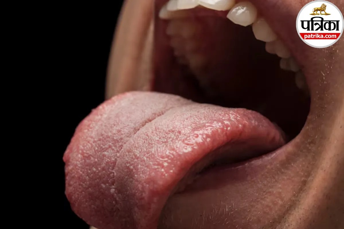 जीभ पर दिखने लगी पीली परत तो न करें नजरअंदाज, क्लीवलैंड क्लिनिक ने बताया Yellow Tongue का हो सकता है संकेत