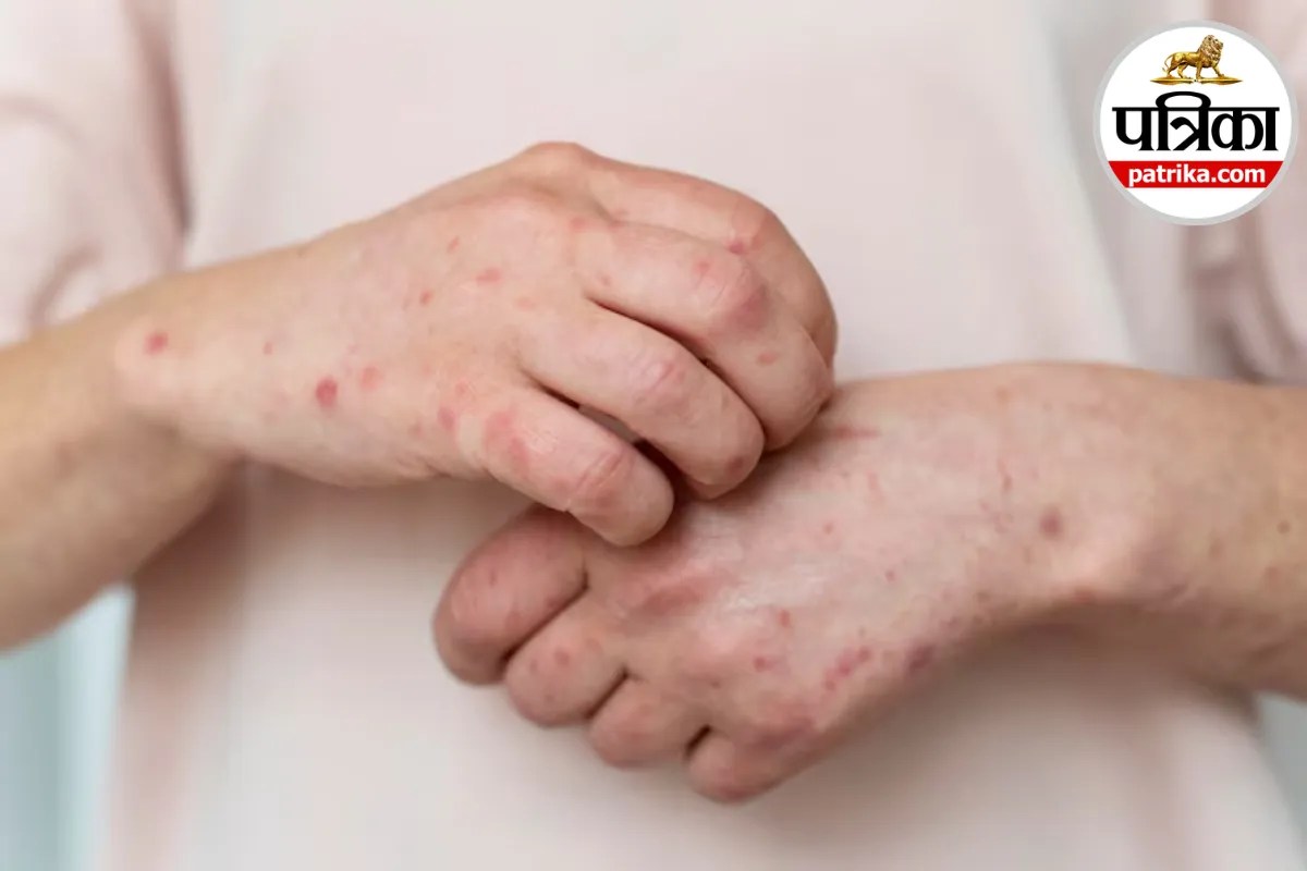Anaphylaxis: अचानक सांस लेने में दिक्कत और गले में सूजन? ये एलर्जी रिएक्शन हो सकता है, क्लीवलैंड क्लिनिक से जानें एनाफिलेक्सिस के संकेत