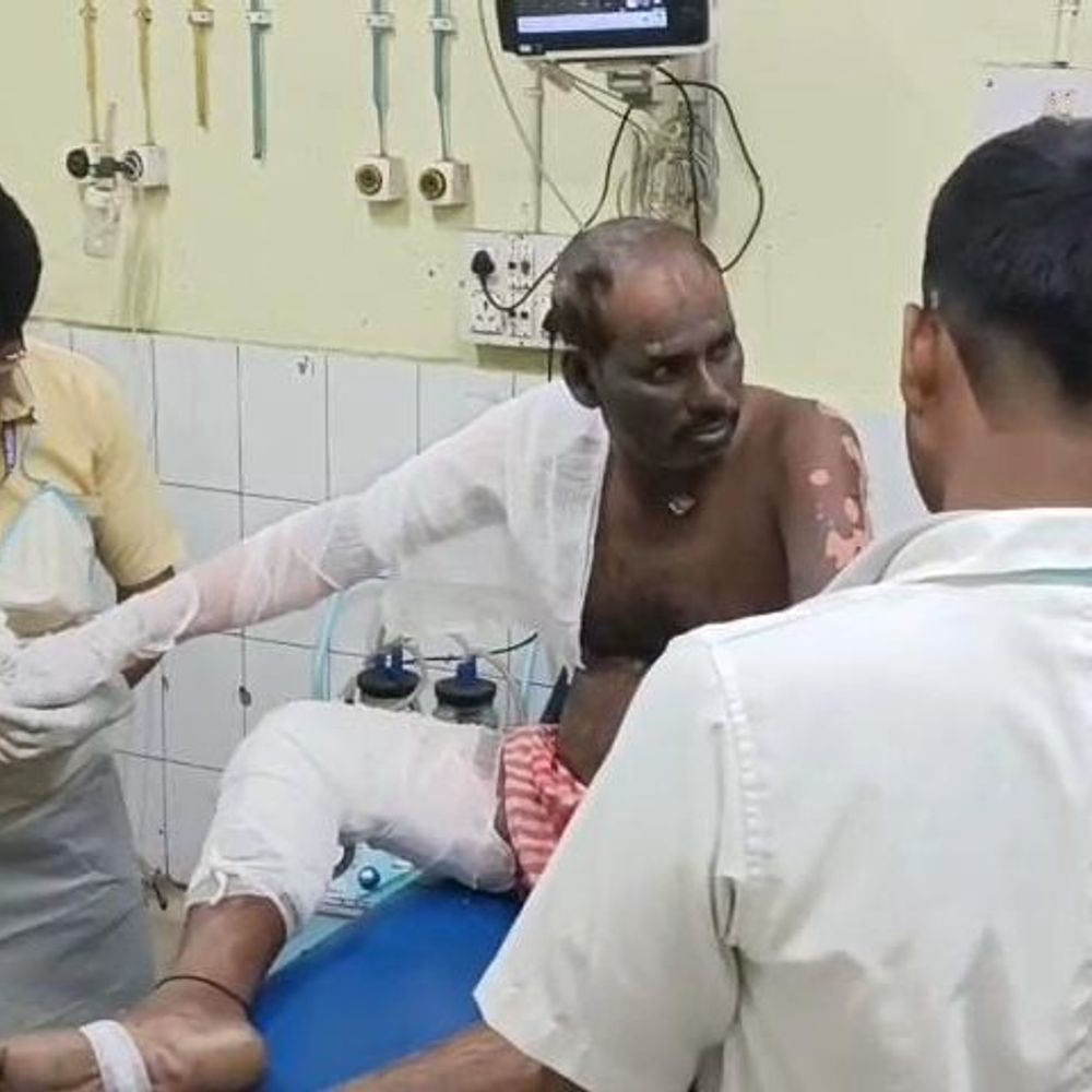 धनबाद के पाथरडीह कोल वाशरी में वेल्डिंग मशीन फटी:हादसे में तीन मजदूर झुलसे, अस्पताल में कराए गए भर्ती; मेंटेनेंस के दौरान हुई घटना