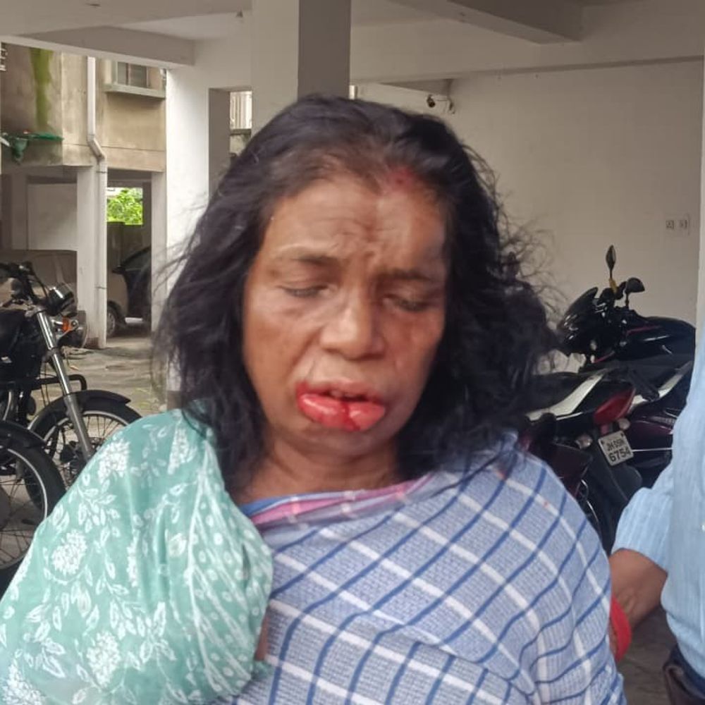 जनगणना कर्मी बनकर महिला के फ्लैट में लूट:बदमाशों ने मारपीट कर जेवर लूटे, महिला को बंधक बनाया, विरोध करने पर तोड़ा दांत