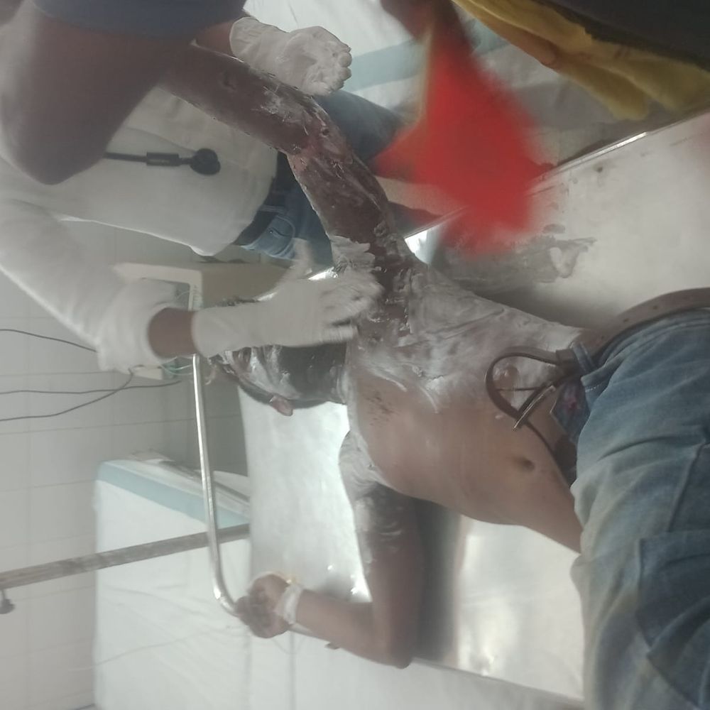 बक्सर में 33 हजार केवीए तार से झुलसा मिस्त्री:शटडाउन के बावजूद हादसा, फर्स्ट एड के बाद सदर अस्पताल रेफर