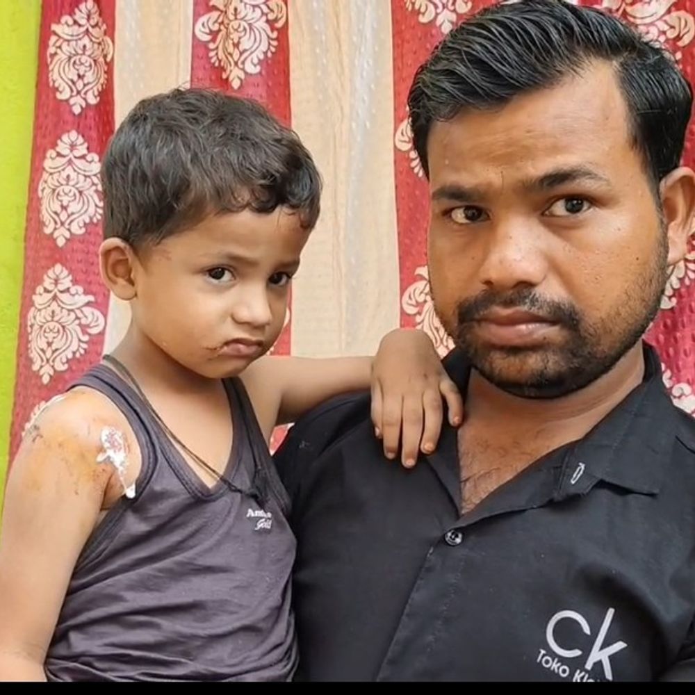 आवारा कुत्ते ने 4 साल के बच्चे को नोचा:मुजफ्फरपुर में घर के बाहर खेल रहा था, कुत्तों के झुंड ने किया हमला