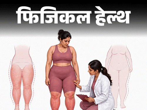 फिजिकल हेल्थ- कमर–जांघों की चर्बी सिर्फ मोटापा नहीं:हो सकता है लिपेडेमा, डॉक्टर से जानें इसके लक्षण, इलाज और बचाव के तरीके