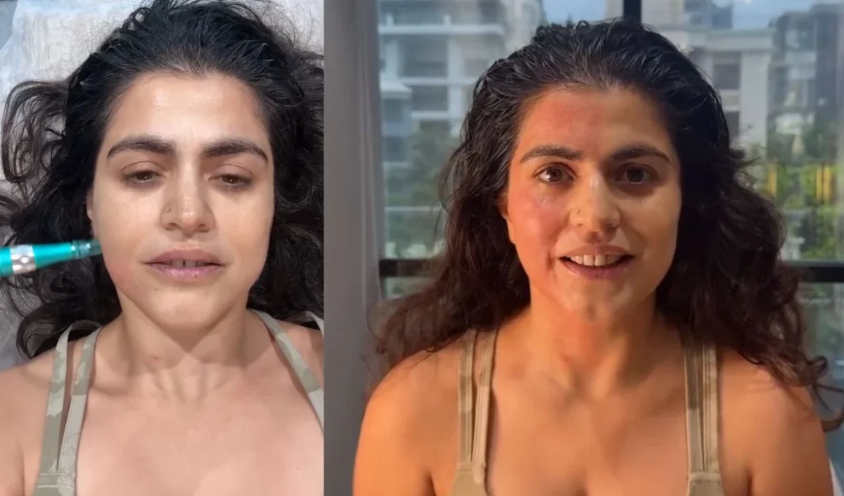 डरावने लुक के बाद मिलता है तुरंत ग्लो, Shenaz Treasury ने बताया Vampire Facial का सच
