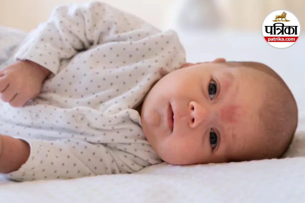 Baby Eczema: बच्चे के चेहरे और सिर पर खुजली-लाल चकत्ते? जानिए नेशनल एक्जिमा एसोसिएशन के अनुसार बेबी एक्जिमा के लक्षण