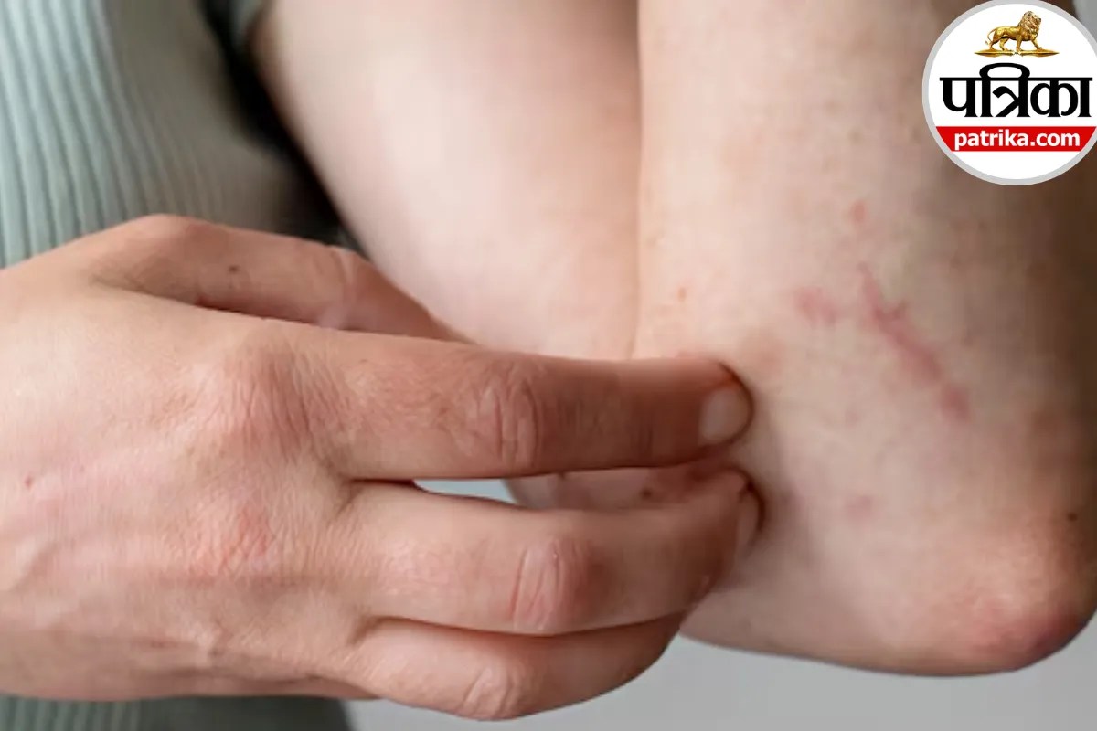 रात में शरीर पर खुजली और लाल चकत्ते? कहीं Bedbugs ने तो नहीं काटा, सीडीसी से जानें लक्षण और कारण