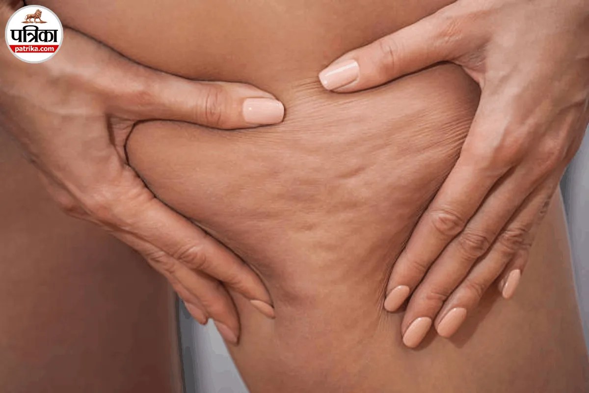 महिलाओं में Cellulite पुरुषों से ज्यादा क्यों दिखता है? Cleveland Clinic से जानें कारण और कम करने के तरीके 