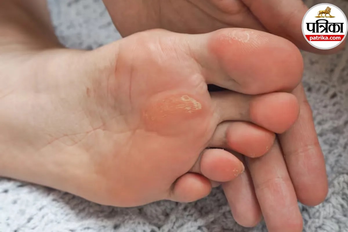 Corns and Calluses: पैरों में बनने वाले कॉर्न और कैलस को न करें नजरअंदाज, मेयो क्लिनिक से जानें क्यों होती है त्वचा मोटी और सख्त