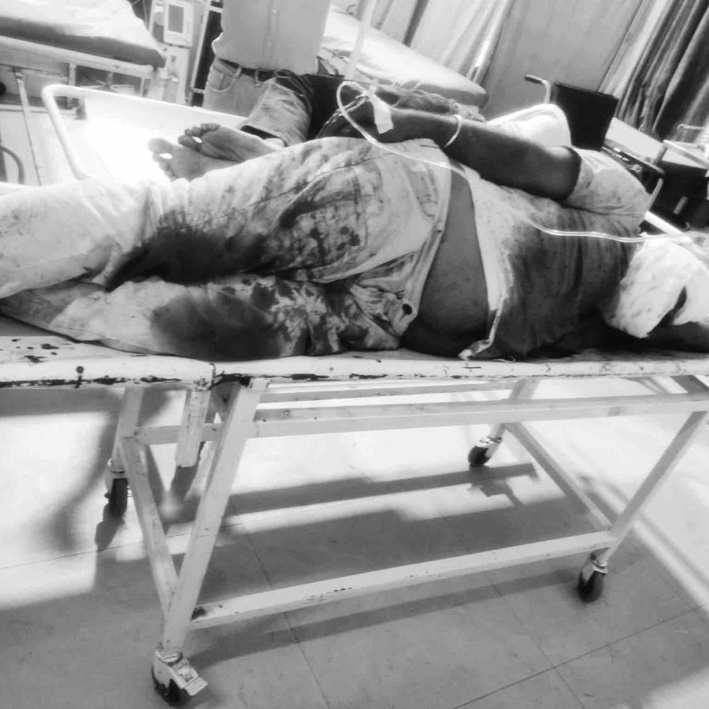 कानपुर के श्यामनगर फ्लाइओवर पर दो बाइक आमने-सामने भिड़ीं:गड्ढों के कारण हादसे में दोनों बाइक सवार गंभीर घायल, एक हैलट रेफर