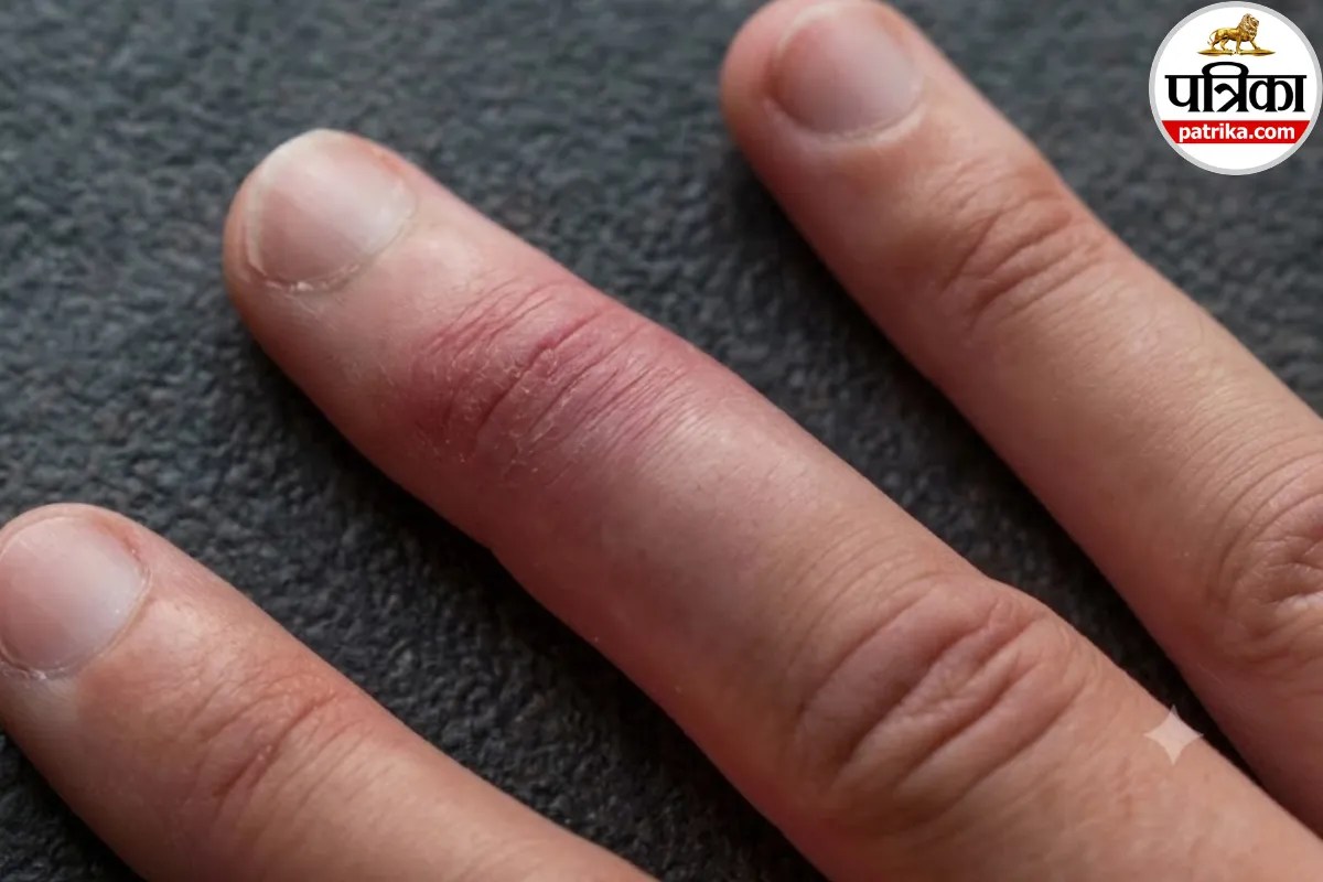 Dactylitis: उंगली की सूजन सिर्फ मामूली समस्या नहीं, डर्मनेट से जानें किन बीमारियों का हो सकती है संकेत