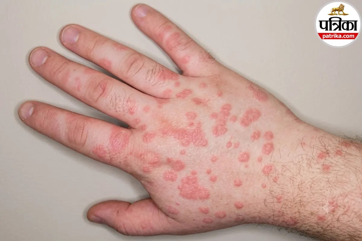 हाथ-पैर पर लाल गोल चकत्ते और बीच में गहरा रंग? Erythema Multiforme का हो सकता है संकेत, डर्मनेट से जानें कारण