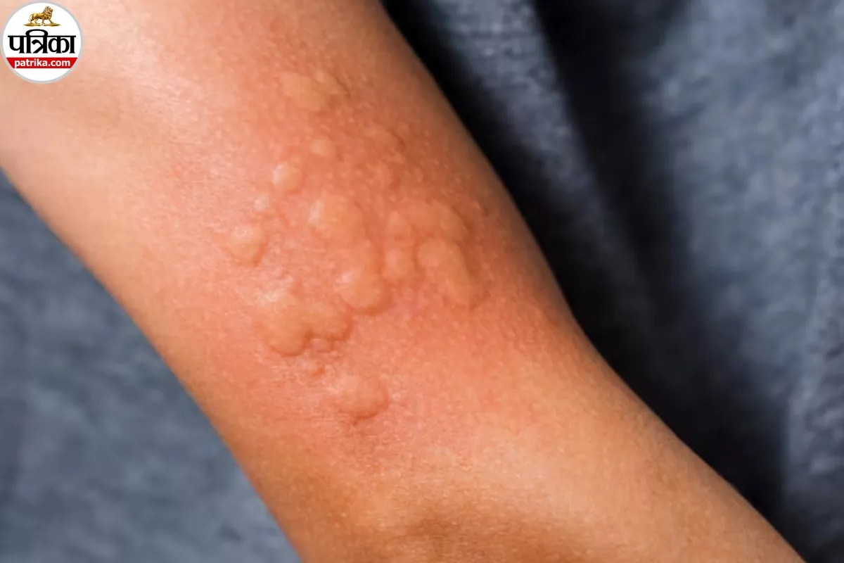 बार बार शरीर पर लाल चकत्ते और खुजली, कहीं Urticaria तो नहीं? Mayo Clinic से जानें इसके कारण