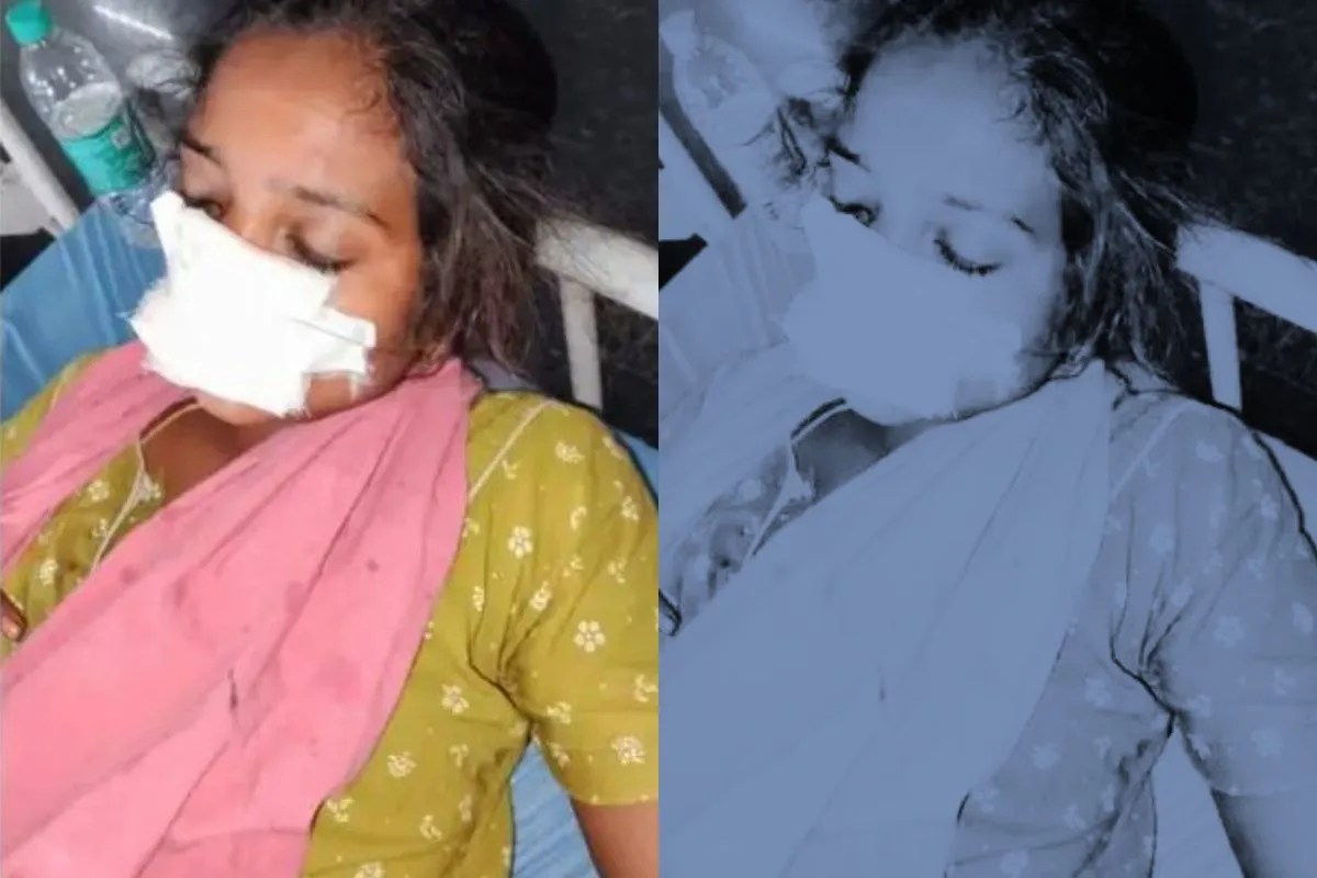 तेलंगाना: घर लौटने से इनकार पर पति ने दांतों से काटी पत्नी की नाक; बीच-बचाव में ससुर को भी किया लहूलुहान